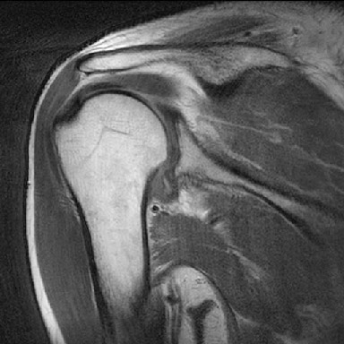견관절낭염 환자의 방사선 영상